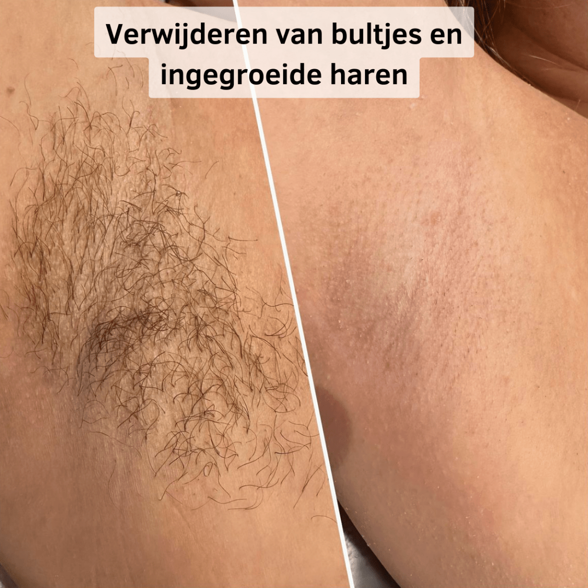 Gladde Huid Scheermes - Belloro Care